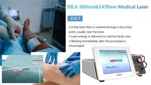 Máquina Médica Láser Nd Yag de 980nm + 1470nm EVLT - Portátil de Alta Potencia <span class=keywords><strong>para</strong></span> la Eliminación de Venas Varicosas y <span class=keywords><strong>Tratamiento</strong></span> Vascular Eficiente - Product Image 2
