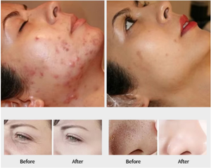 Máquina Hidrofacial 3 en 1 para Uso Clínico, Tendencia 2026, con Agua, Oxígeno, Ultrasonido, Blanqueamiento y Dermoabrasión - Product Image 4