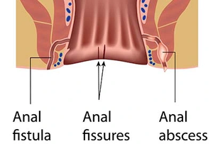 Clínica Anal fístula mejor 980nm y 1470nm diodo láser hemorroides Diodo para cuerpo Material ABS para tratamiento de hemorroides Hospital - Product Image 4