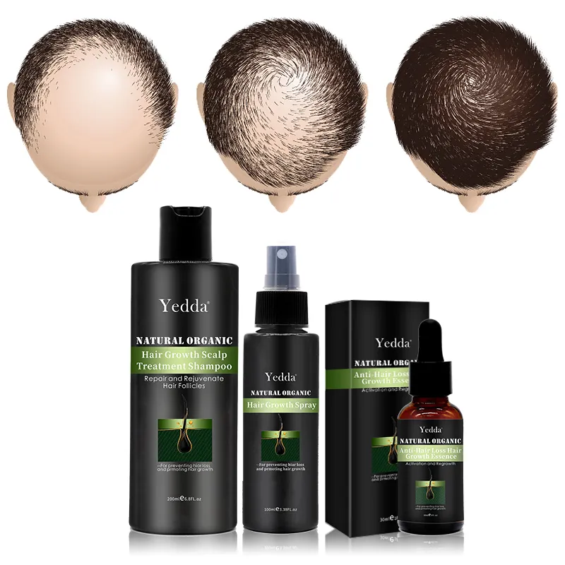 Fórmula a base de hierbas eficaz aerosol de crecimiento de cabello para crecer pelo en la calvicie zona