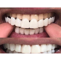 Kit de Blanchiment Dentaire Temporaire en Silicone Gel pour Fausses Dents, Appareil Buccal, Prothèses Dentaires, Facettes Sourire Parfait, Pâte Adhésive avec Boîte