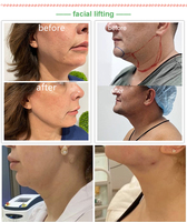 Équipement de liposuccion Vaser Lipo, canule de liposuccion pour amincissement des graisses, laser diode 980/1470 nm, lipolyse endolaser, machine de lifting