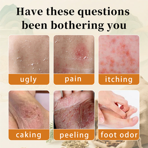 Crema anti-picazón puramente vegetal, adecuada para afecciones de la piel como picaduras de mosquitos, alergias, <span class=keywords><strong>dermatitis</strong></span>, etc. - Product Image 4