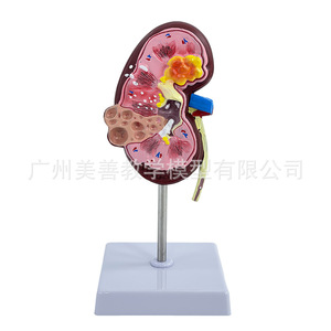 Simulation pédagogique de la structure et de l'anatomie du rein humain ; organes internes malades ; urologie ; glomerules ; néfons - Product Image 3