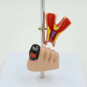 Model Patologi Komplikasi <span class=keywords><strong>Diabetes</strong></span> Bersertifikat CE Mata/Jantung/Ginjal/Selang Pendarahan/Kaki untuk Demonstrasi Pendidikan Medis - Product Image 2