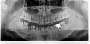 Appareil d'imagerie <span class=keywords><strong>panoramique</strong></span> et céphalométrique <span class=keywords><strong>dentaire</strong></span> simple d'utilisation, innovation en matière d'imagerie - Product Image 4