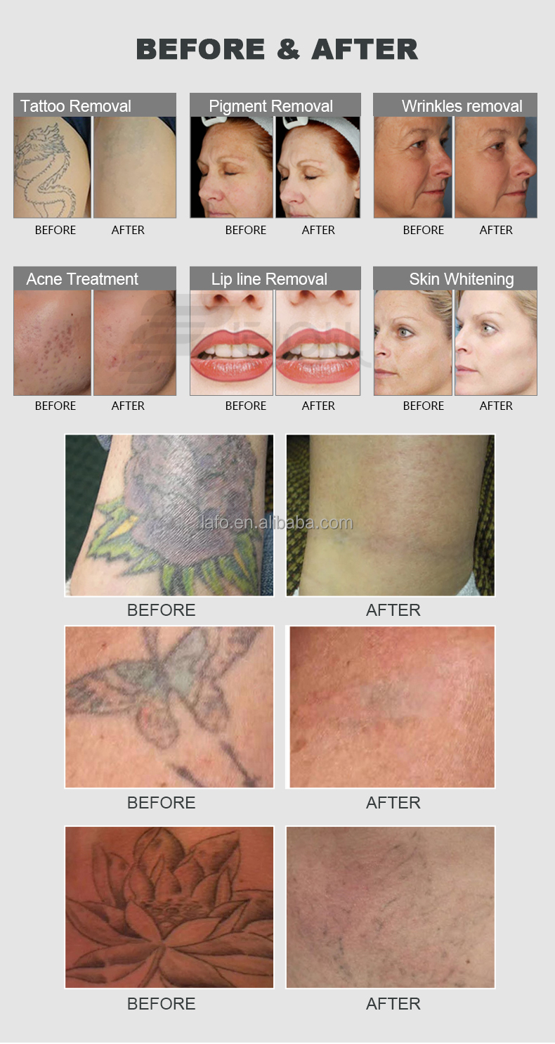 532nm1064nm ndyag laser tattoo removal machine price / pico second laser for eyebrow tattoo removal skin whitening
