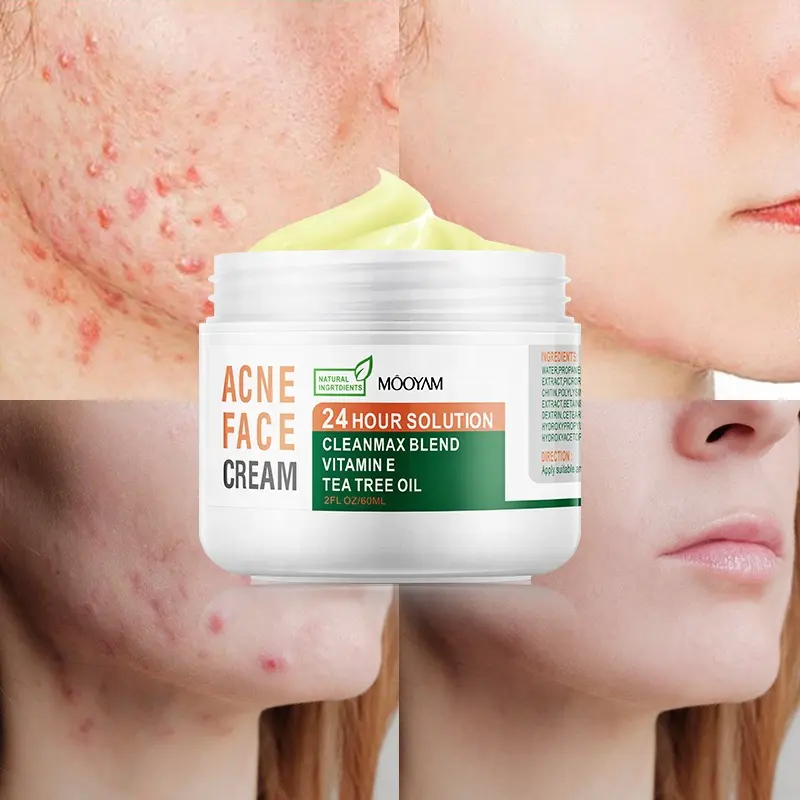 Herbal Treatment Skin Face Acne Scar Pimples Dark Spot Remover Vitamin E Tea Tree Oil Anti Acne Cream