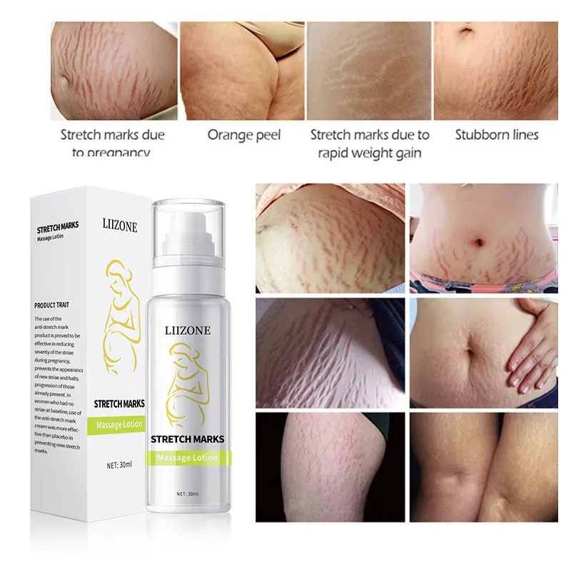 Women Pregnancy Anti Stretch Marks Removal Cream Private Label Strong Efficacy Stretch Marks Remover Cream for body legs