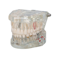 Modèle dentaire transparent d'implant dentaire, modèle de restauration de couronne et de pont amovible pour la démonstration pédagogique des dentistes