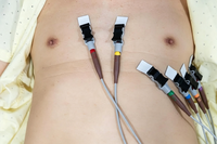 Électrode radiotransparente professionnelle pour surveillance, transmission de signal stable et conductrice, jetable, médicale, 23*34