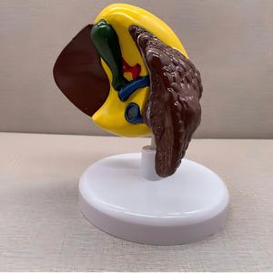 แบบจำลองการสอนเกี่ยวกับมะเร็งตับพร้อมฐาน - เครื่องมือกายวิภาคที่ถอดออกได้สำหรับการศึกษาโรคตับ - Product Image 2