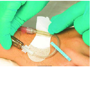 อุปกรณ์ซ่อมสายสวนหลอดเลือด3*9ซม. ผลิตภัณฑ์ทางการแพทย์แบบใช้แล้วทิ้งจากโรงงาน - Product Image 5