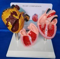 Modèle anatomique comparatif du cœur d'un fumeur KyrenMed, modèle pathologique du cœur, comparaison du cœur sain et du cœur fumeur