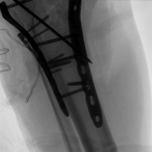 MSL MSLCX20 5.0KW dijital <span class=keywords><strong>C</strong></span> kol <span class=keywords><strong>X</strong></span> <span class=keywords><strong>Ray</strong></span> makinesi ve çok amaçlı ameliyat masası uyumlu radyografi tanı sistemi - Product Image 6