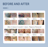 Láser Portátil Taibo Yag 2026, Láser Pico para Tatuajes de Cejas, Picotech Nd Yag, Máquina de Belleza, Láser de Picosegundos para Cuidado Facial y Corporal