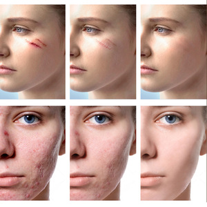 Crema cicatriziale al coccodrillo per rimuovere Acne e smagliature crema viso e trattamento lozione - Product Image 4