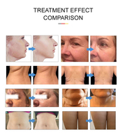 Appareil Hifu 7D pour le lifting du visage et le remodelage corporel, resserrement cutané pour usage clinique, brosse de nettoyage