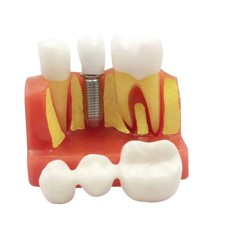 Dental Modell Implant Analyse Crown Brücke Demonstration Zähne Modell für für Patienten Kommunikation und Bildung