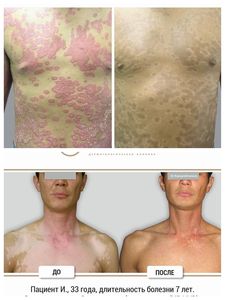 Machine <span class=keywords><strong>de</strong></span> photothérapie UVB à grande armoire pour hôpitaux Armoire <span class=keywords><strong>de</strong></span> <span class=keywords><strong>luminothérapie</strong></span> UVB 311 nm à bande étroite UVB Full Body - Product Image 5