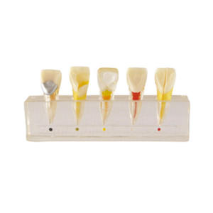 Modelo clínico para ensino de dentes, modelo de doença dentária da polpa, modelo clínico para ensino de dentes - Product Image 1