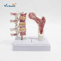 Modelo de Lesión de Osteoporosis en 2 Partes: Columna Vertebral y Fémur Proximal Patológicos, PVC Pintado a Mano, Ideal para la Educación del Paciente