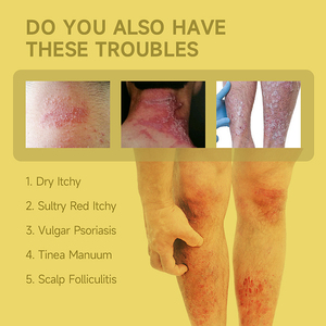 Zourunan Relieve Itchy <strong>Cream</strong> 20g External Skin Comfort Yellow Tube Wholesale Sourcing - Product Image 2