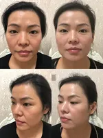 OEM 딥 바이오 콜라겐 페이스 리프팅 세럼 안티에이징 페이셜 스킨 안티링클 리퀴드 가수분해 트리플 콜라겐 MTS 테라피아 세럼