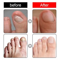 Solution de Soin des Ongles des Pieds de l'Usine de Guangzhou avec Hydratation et Nettoyage Doux pour les Ongles des Pieds