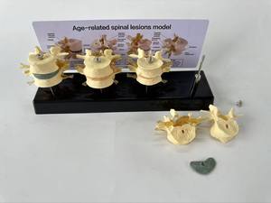 Vertebra lombare malata modello di ernia disco osteoporosi insegnamento ortopedico umano modello di comunicazione medico-paziente - Product Image 3