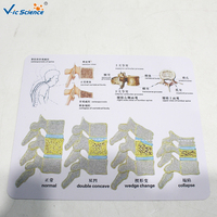 Modelo Anatómico de Patología de Densidad Ósea, Ayuda de Demostración Científica Popular sobre Osteoporosis, CE/ISO/ROHS/CNAS