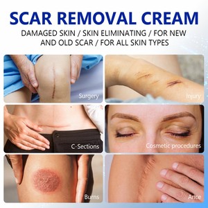 Crème <span class=keywords><strong>anti</strong></span>-vergetures pour la <span class=keywords><strong>grossesse</strong></span>, crème de soin de la peau, cosmétiques de beauté, sûre, végétalienne, crème de suppression des cicatrices - Product Image 5