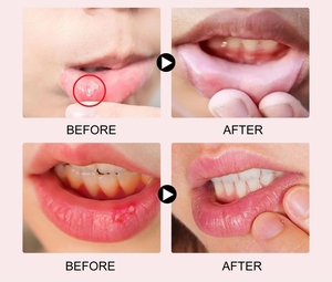 A 2025 El uso doméstico más vendido El dolor frío 660nm 850nm Reduce la inflamación para el herpes <span class=keywords><strong>labial</strong></span> y el acné - Product Image 3