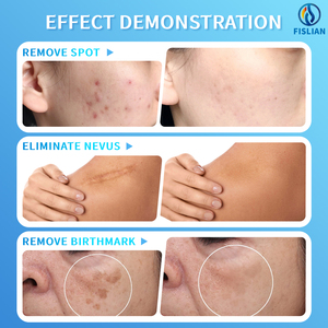 Sistema di Epilazione Elettrolitica Tutto-<span class=keywords><strong>in</strong></span>-Uno, Macchina Portatile da Tavolo per Rimozione Permanente dei Peli su Viso e Corpo - Product Image 5