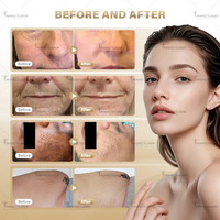 Machine de resurfaçage cutané au laser CO2 homologuée CE médicale OEM, 80 W, 10600 nm, machine de resurfaçage fractionné au laser CO2 pour le resserrement vaginal, prix