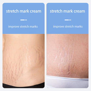 Crème nourrissante spéciale <span class=keywords><strong>pour</strong></span> <span class=keywords><strong>les</strong></span> <span class=keywords><strong>vergetures</strong></span> pendant la <span class=keywords><strong>grossesse</strong></span> et après l'accouchement, crème réparatrice <span class=keywords><strong>pour</strong></span> <span class=keywords><strong>les</strong></span> <span class=keywords><strong>vergetures</strong></span> - Product Image 5