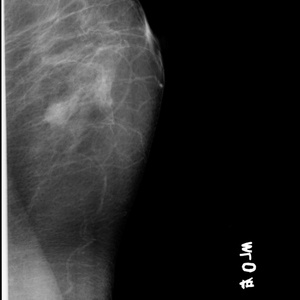 Equipo Radiológico Más Vendido, Máquina de Mamografía de Rayos X con Generador de Alta Frecuencia y Alto Voltaje de Estado Sólido Completo MX-98B - Product Image 3