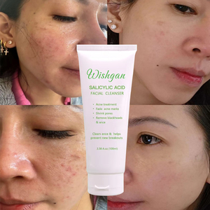 <span class=keywords><strong>Limpiador</strong></span> de poros, ácido salicílico, tratamiento para el acné, <span class=keywords><strong>limpiador</strong></span> Facial antiacné, elimina espinillas y limpieza profunda, lavado de cara para el acné - Product Image 1