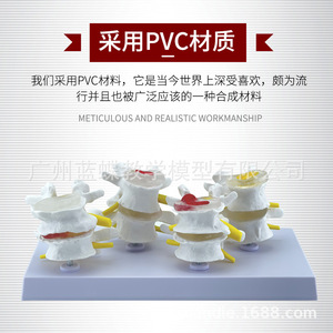 Modelo patológico de columna lumbar de cuatro etapas; modelo esquelético patológico; esqueleto deformado; modelo de columna vertebral patológica. - Product Image 1