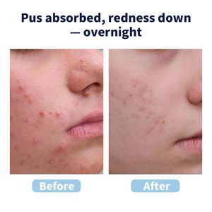 Traitement hydrocolloïde médical kystique Traitement de l'acné Zit Patches <span class=keywords><strong>Gunk</strong></span> Out Blackhead & Pore Extractor Pimple Patches pour le visage - Product Image 5