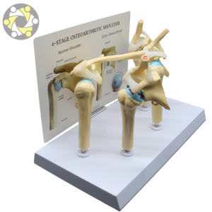 Médico enfermo 4 etapa osteoartritis <span class=keywords><strong>hombro</strong></span> modelo de enseñanza - Product Image 1