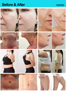 <b>Smart</b> Freezewave Therapy Device Back Fat Removal Double Chin Disappearing <b>Improve</b> Skin Elasticity Touch Screen - Product Image 6