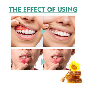 OEM 25ml <span class=keywords><strong>Spray</strong></span> de soulagement de la bouche Ulcères buccaux Caries dentaires Saignement des gencives Soulagement de la bouche <span class=keywords><strong>Spray</strong></span> nettoyant - Product Image 5