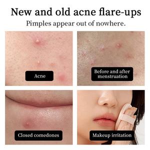 Parches Hidrocoloides Invisibles para el Acné, Coloridos, con Forma de Estrella, 40 Parches, Removibles, Cómodos, Tratamiento para el Acné, <span class=keywords><strong>Cubre</strong></span> <span class=keywords><strong>Imperfecciones</strong></span> Faciales - Product Image 4