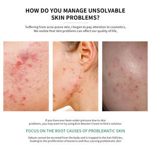 Crème Booster Anti-Acné Personnalisée à la Centella Asiatica <span class=keywords><strong>pour</strong></span> Peaux Grasses, Extrait d'Arbre à Thé, Baume Hydratant Éliminateur de Cicatrices d'Acné - Product Image 3