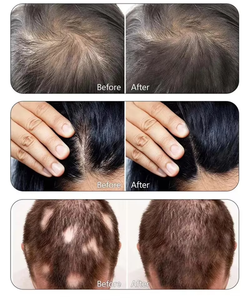 เครื่องวิเคราะห์หนังศีรษะและเส้นผมอเนกประสงค์ 15 นิ้ว 5-in-1 ความถี่สูง สำหรับฟื้นฟูและกระตุ้นการเจริญเติบโตของเส้นผม - Product Image 6