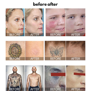 Máy laser Picosecond <span class=keywords><strong>Q</strong></span>-<span class=keywords><strong>switch</strong></span> ND YAG Seaheart 2025 dùng để xóa hình xăm mày - Product Image 5