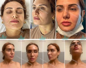 2024 yeni satış 980 1470nm diyot endo lazer makinesi vaser liposuction makinesi kanül set ünitesi cihazı - Product Image 4