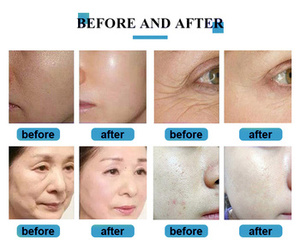 เครื่องขัดผิวให้สะอาดอย่างล้ำลึกแบบ8ใน<span class=keywords><strong>1</strong></span>,เครื่องขัดผิวให้ความชุ่มชื้นด้วยออกซิเจนดูแลผิวหน้าเครื่องขัดผิวด้วย Jet Peel Microdermabrasion - Product Image 3