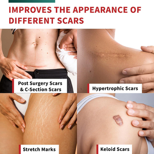 Cinta <span class=keywords><strong>de</strong></span> Gel <span class=keywords><strong>de</strong></span> Silicona <span class=keywords><strong>de</strong></span> Grado Médico YOJO para el Cuidado <span class=keywords><strong>de</strong></span> Cicatrices, Reutilizable, Hipoalergénica, Sin Látex, Desinfectada <span class=keywords><strong>con</strong></span> EO, Cinta Adhesiva - Product Image 6